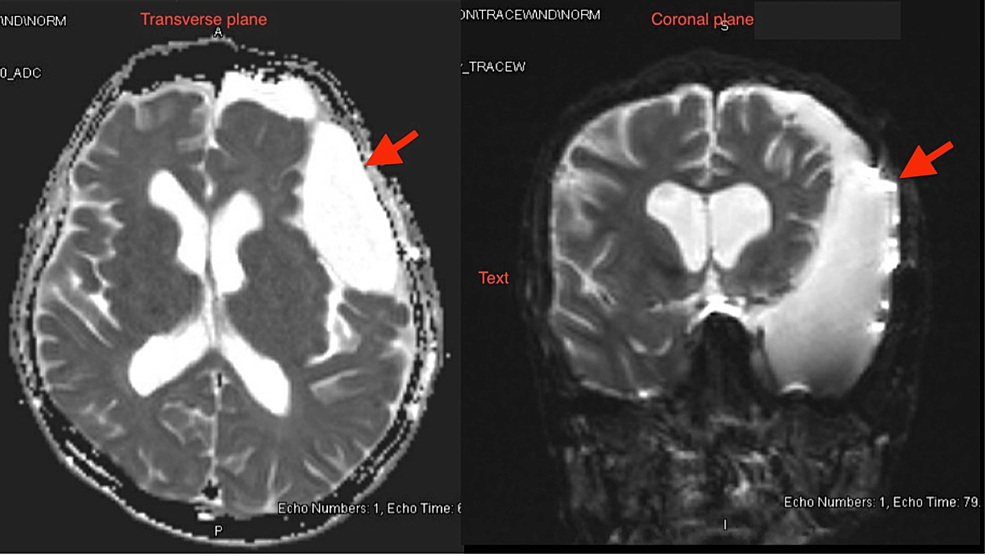 Arachnoid Cyst A Sudden Deterioration Cureus