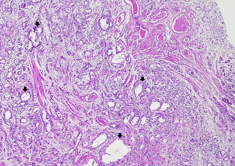 Nephrogenic Adenoma Of The Prostatic Urethra Mimicking Prostatic And