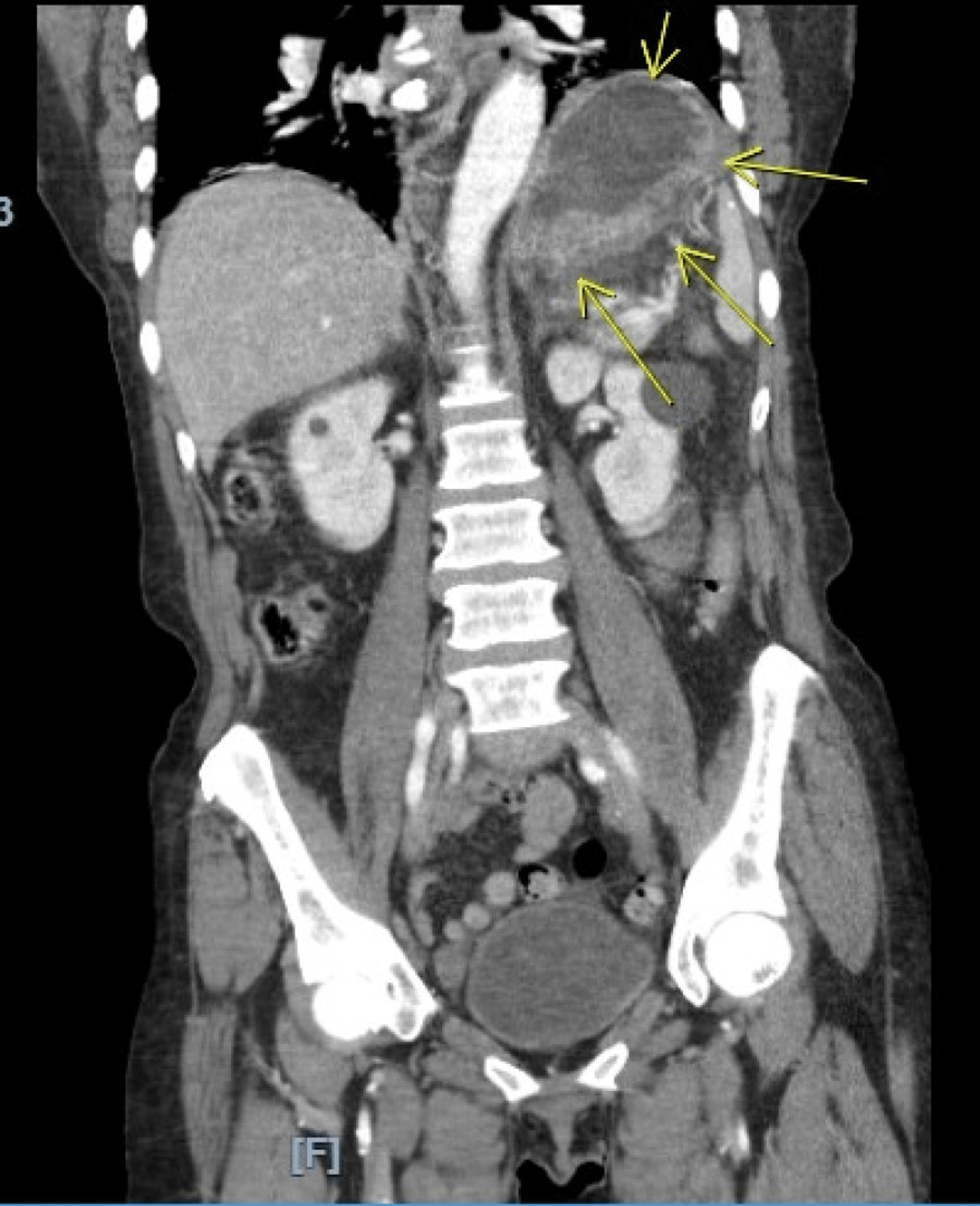 Chronic Lymphocytic Leukemia Causing Gastric Ulcer Perforation A Case