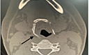 A Rare Isolated Hyoid Bone Fracture A Case Report And Review Of The