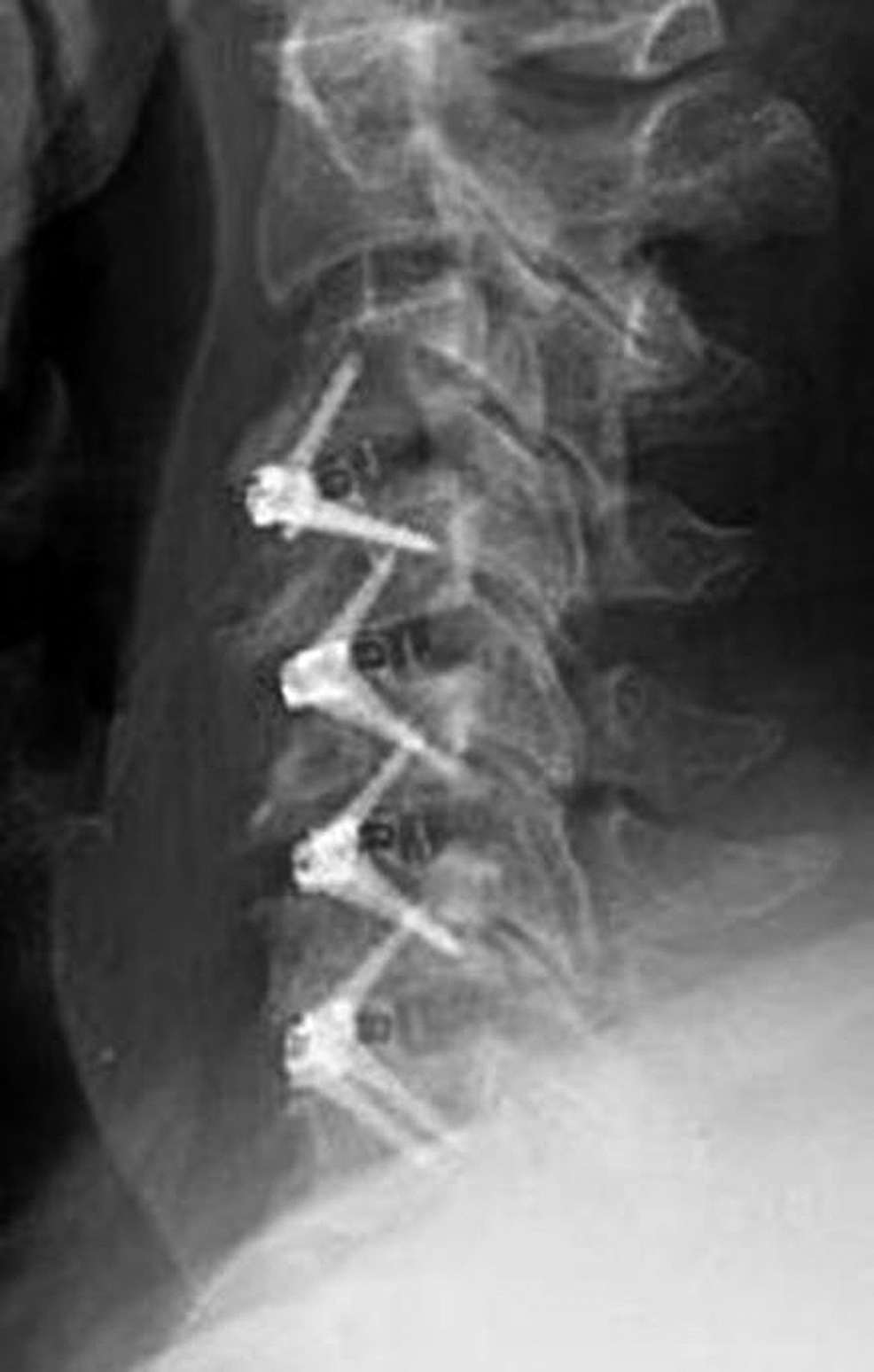 Cervical Radiculopathy remedy videos