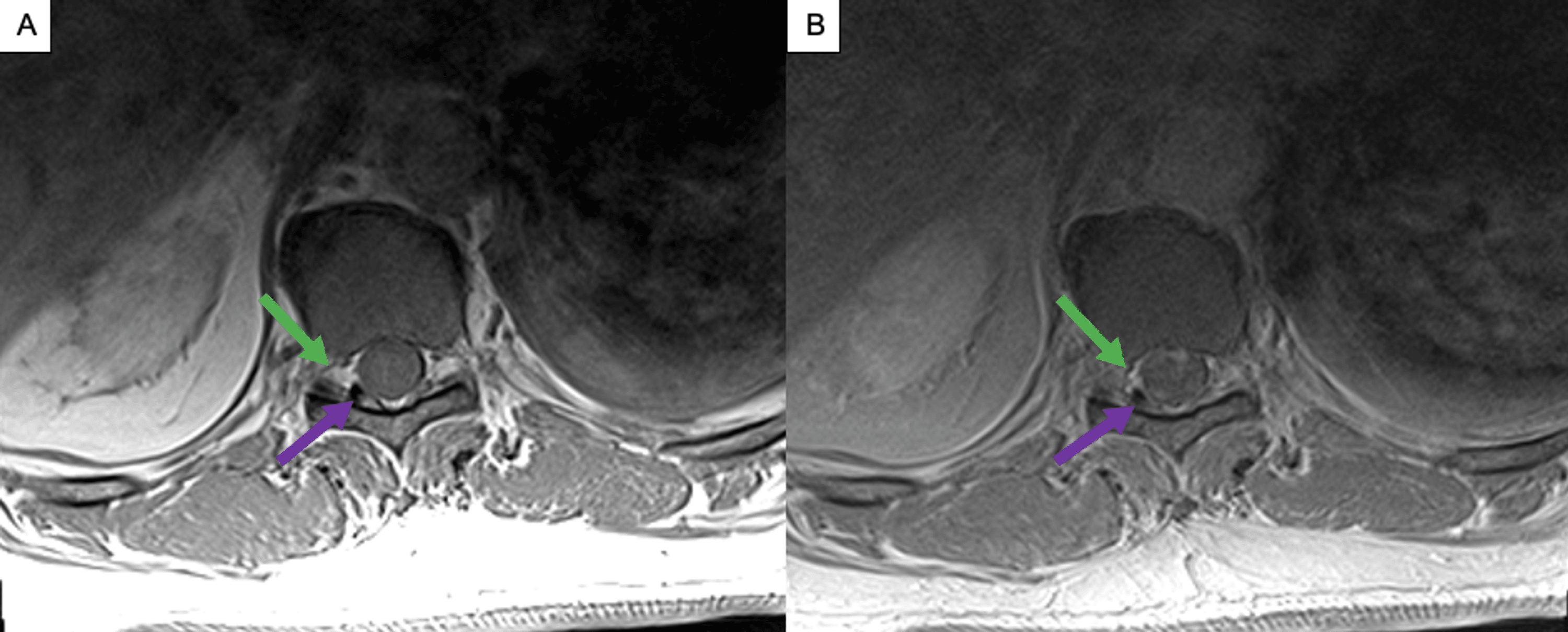 Surgical Management Of A Spinal Dural Arteriovenous Fistula Cureus