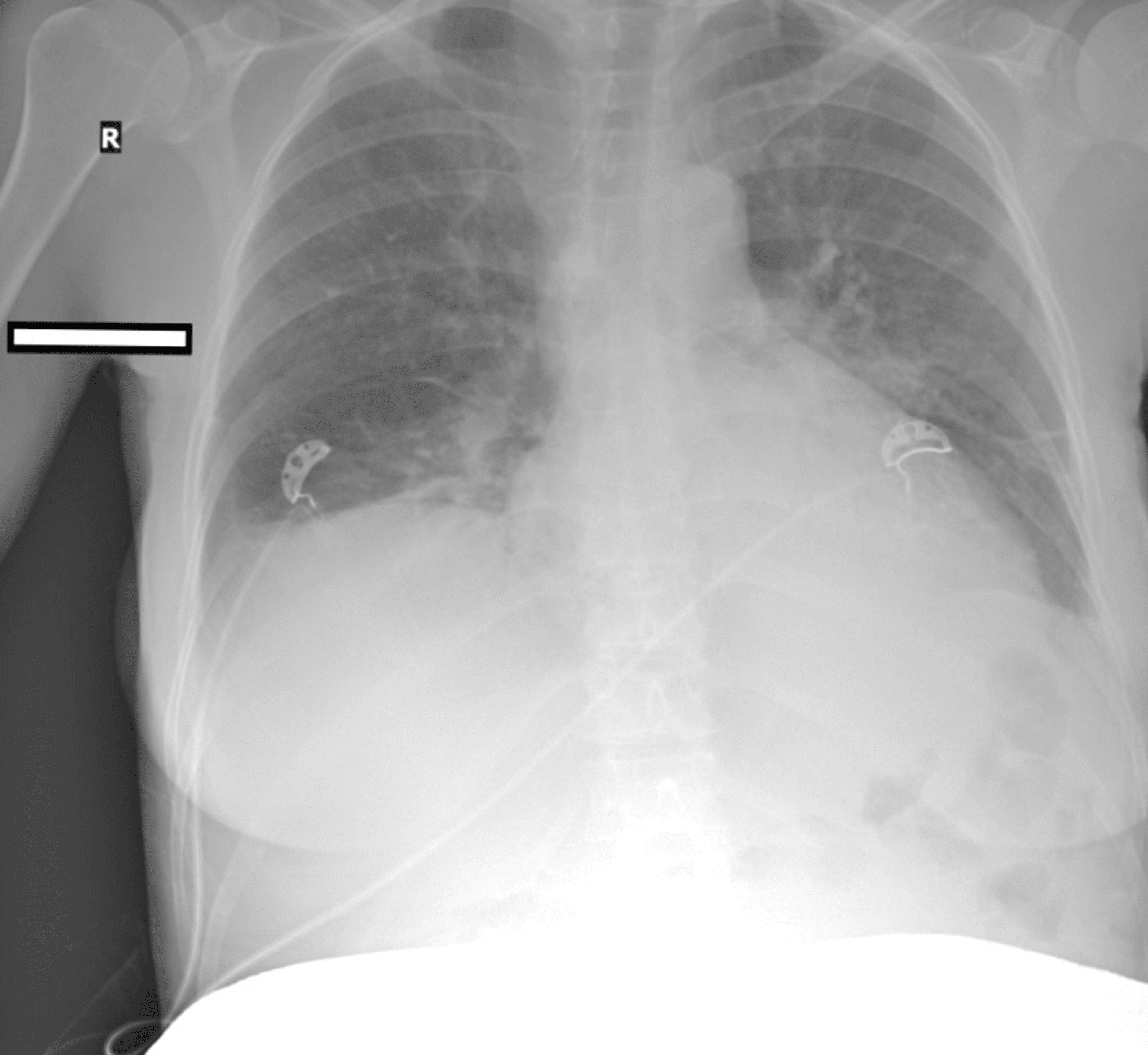 Cureus Non Cardiogenic Pulmonary Edema Due To Administration Of Atosiban