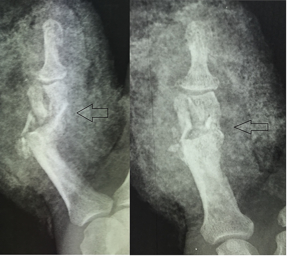 A Bridging Distraction External Fixation For A Severely Comminuted