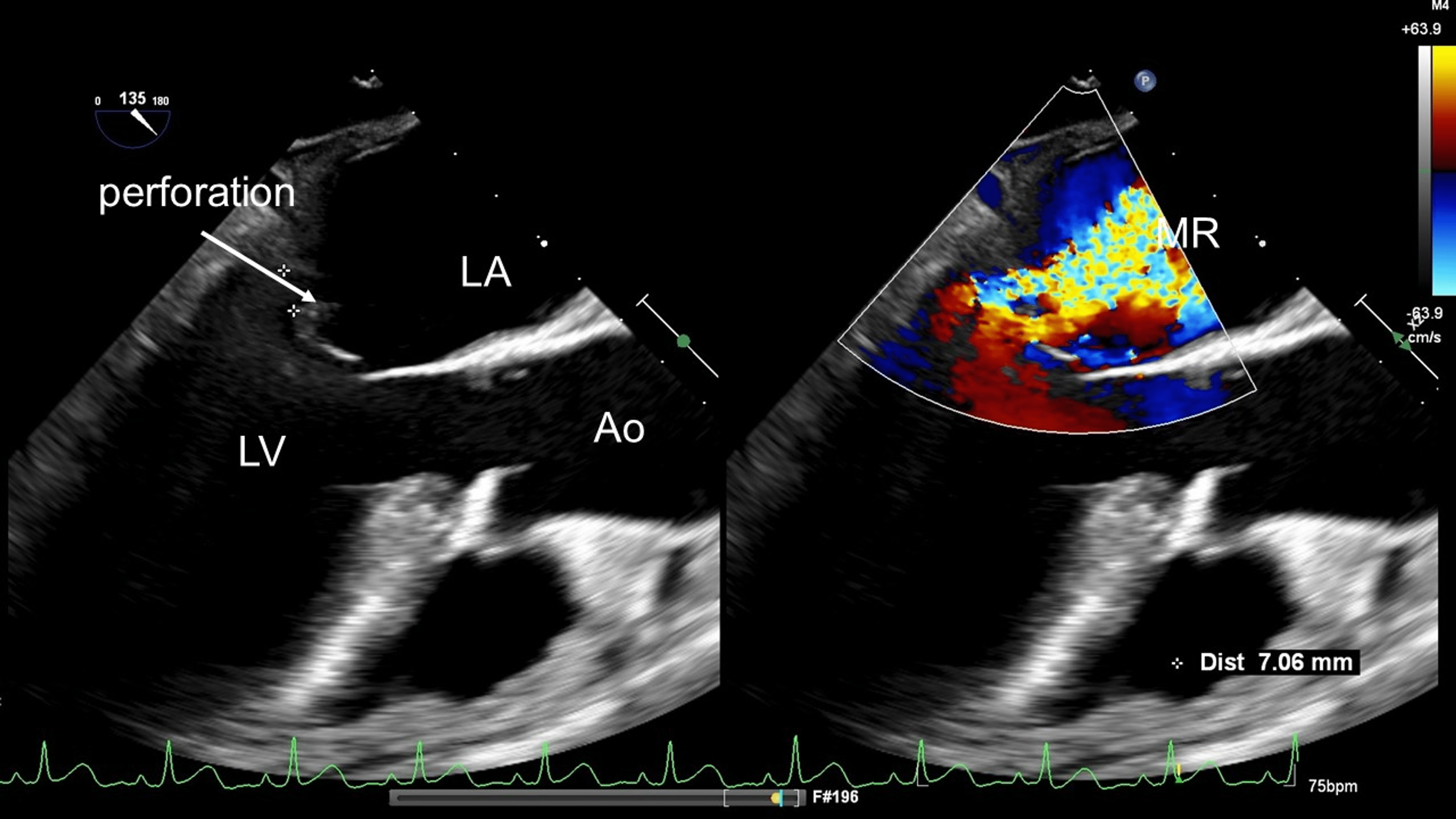 Cureus Posterior Mitral Leaflet PML Perforation Due To Infective Endocarditis IE