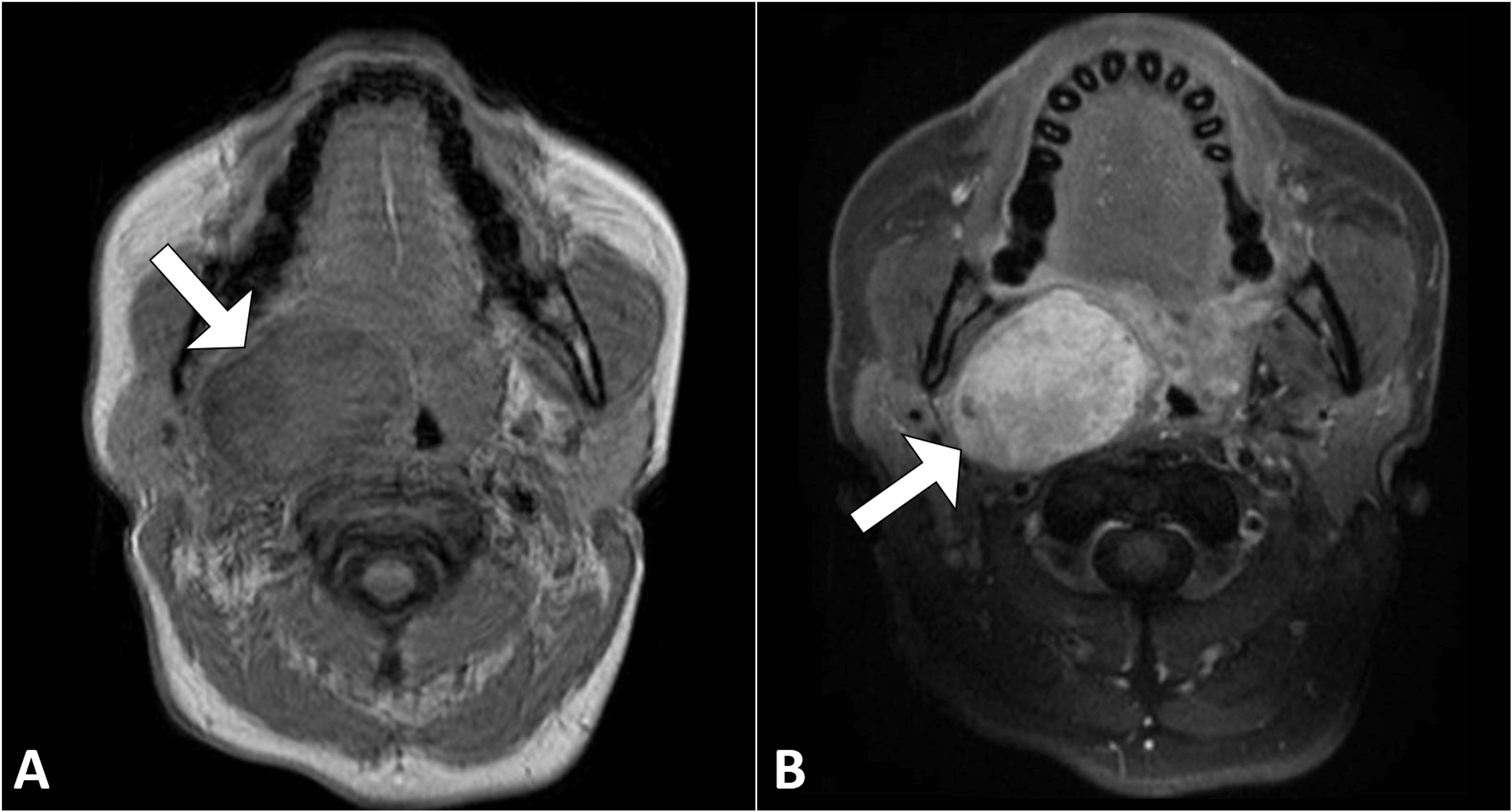 Cureus Pleomorphic Adenoma Of The Deep Lobe Of The Parotid Gland