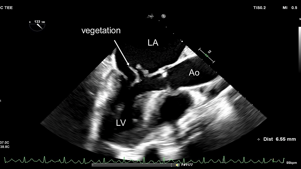 Cureus Posterior Mitral Leaflet Prolapse And Subsequent Mitral Valve Endocarditis Complicated