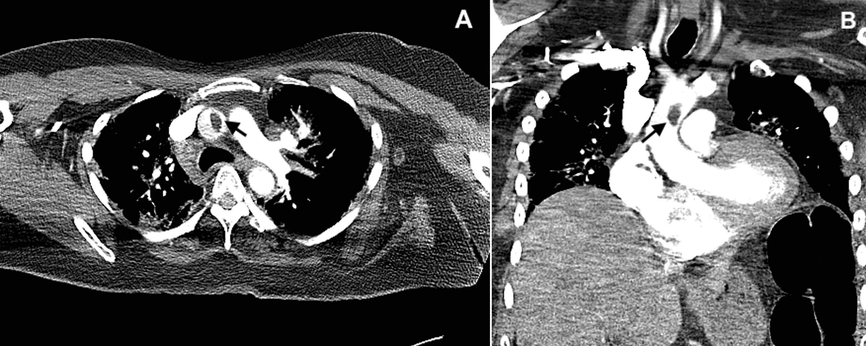 Cureus COVID 19 Associated Coagulopathy Ascending Aortic Thrombus