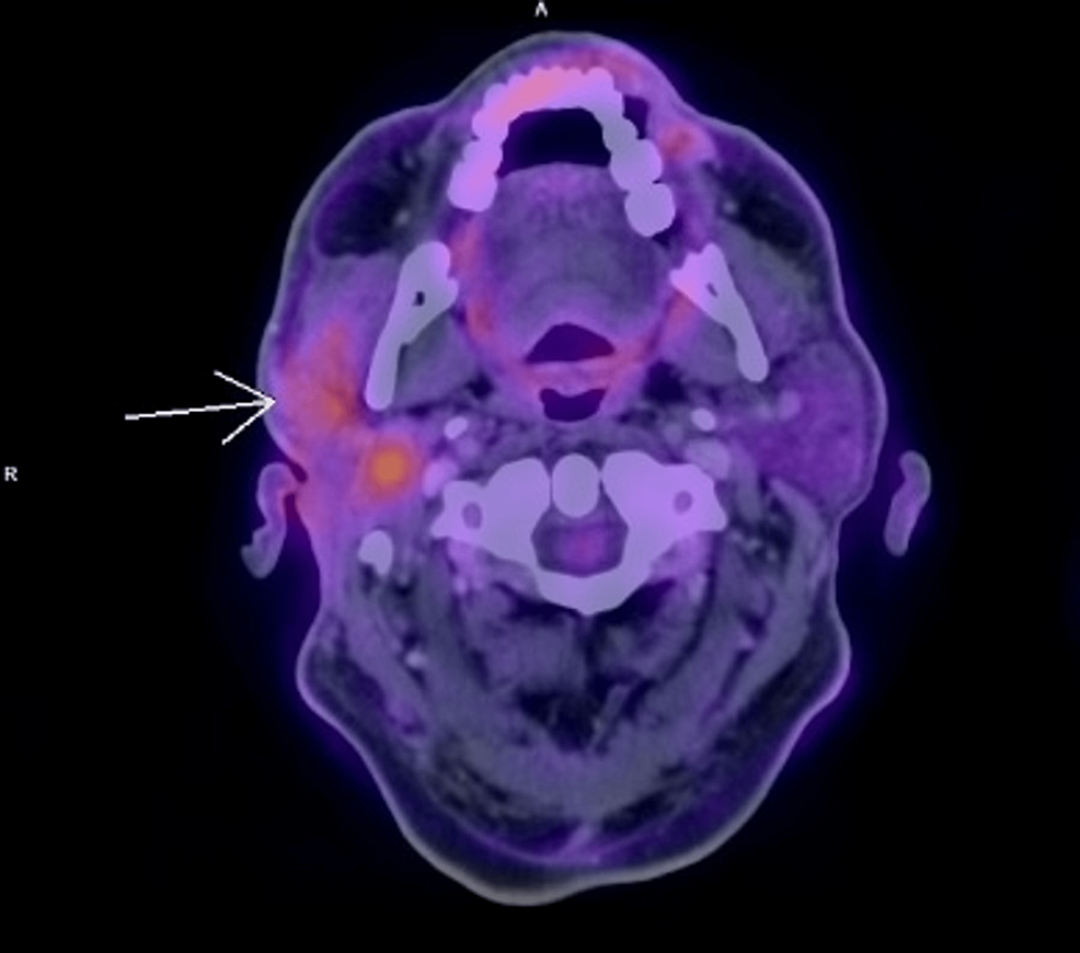 Warthins Tumor Of The Parotid Gland With Degeneration To Diffuse Large