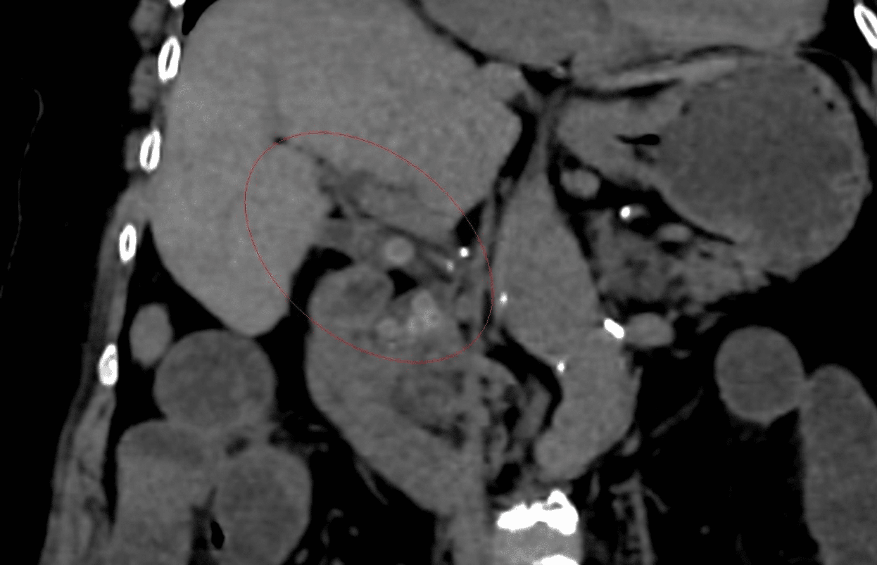 Cureus Gallstone Ileus With Cholecystoenteric Fistula In An Elderly