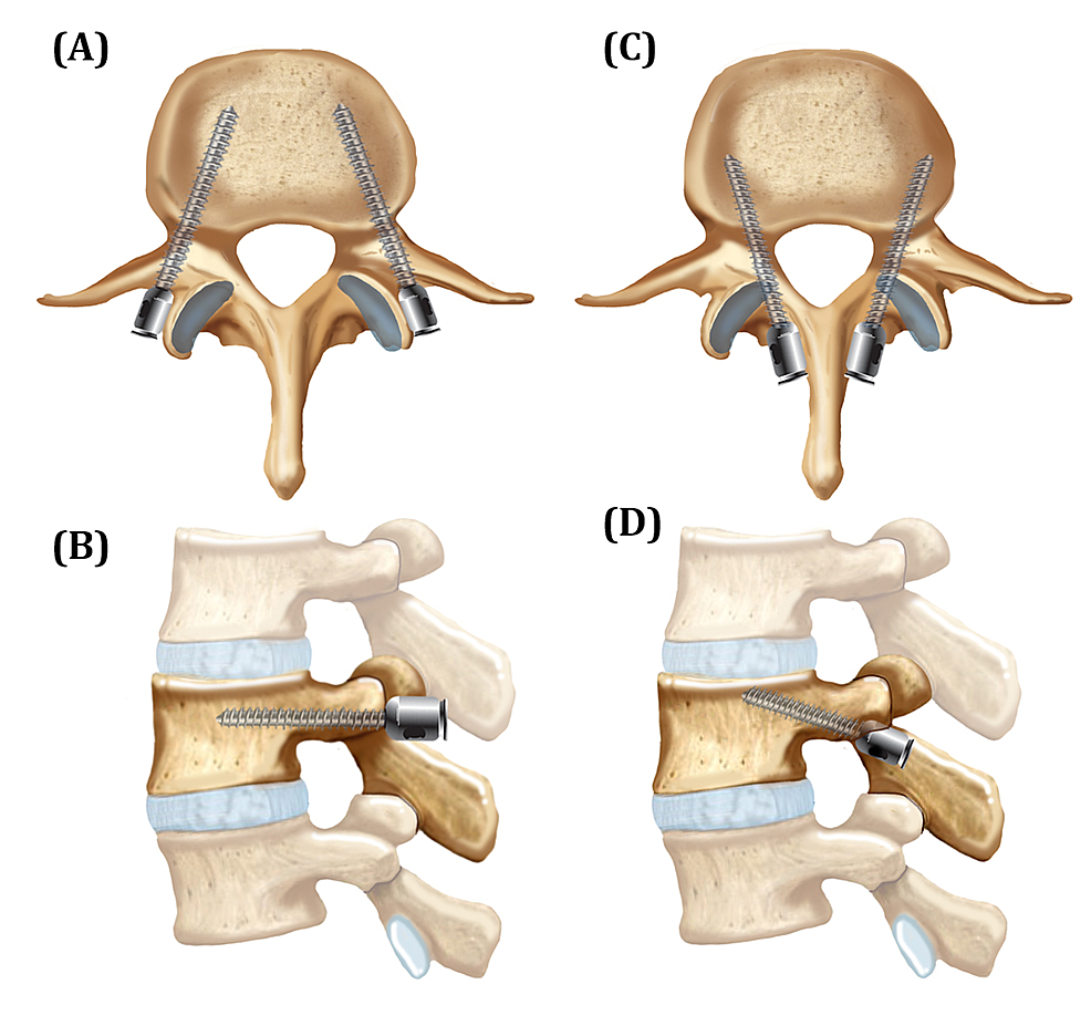 screw fixation for odontoid fracture