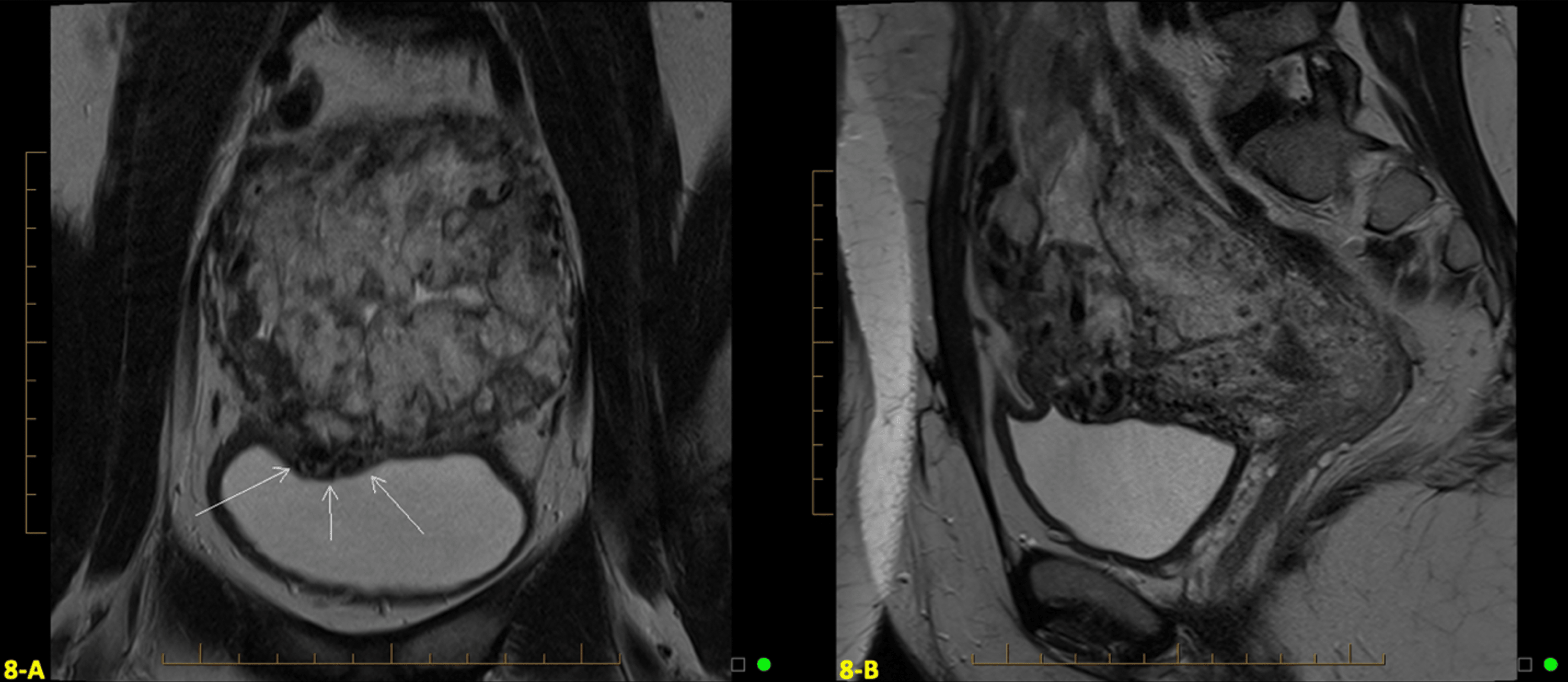 Cureus Sonographic Diagnosis And Management With Delayed Hysterectomy