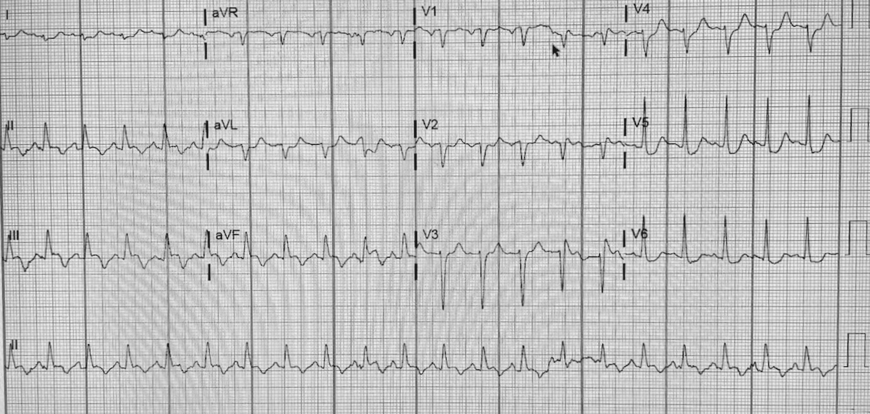 Cureus Report On Rare Complication Post Silent Myocardial Infarction