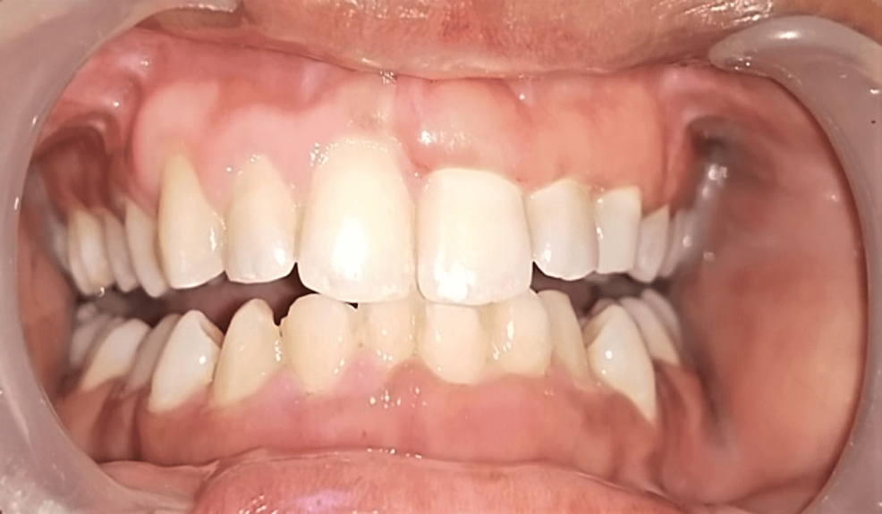 Vitamin D Deficiency And Gingival Enlargement A Case Report Cureus