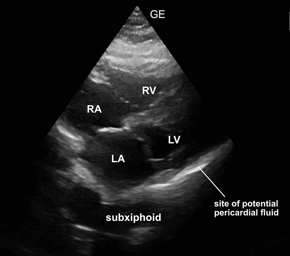 Anatomical Correlation For Focused Assessment With Sonography In Trauma