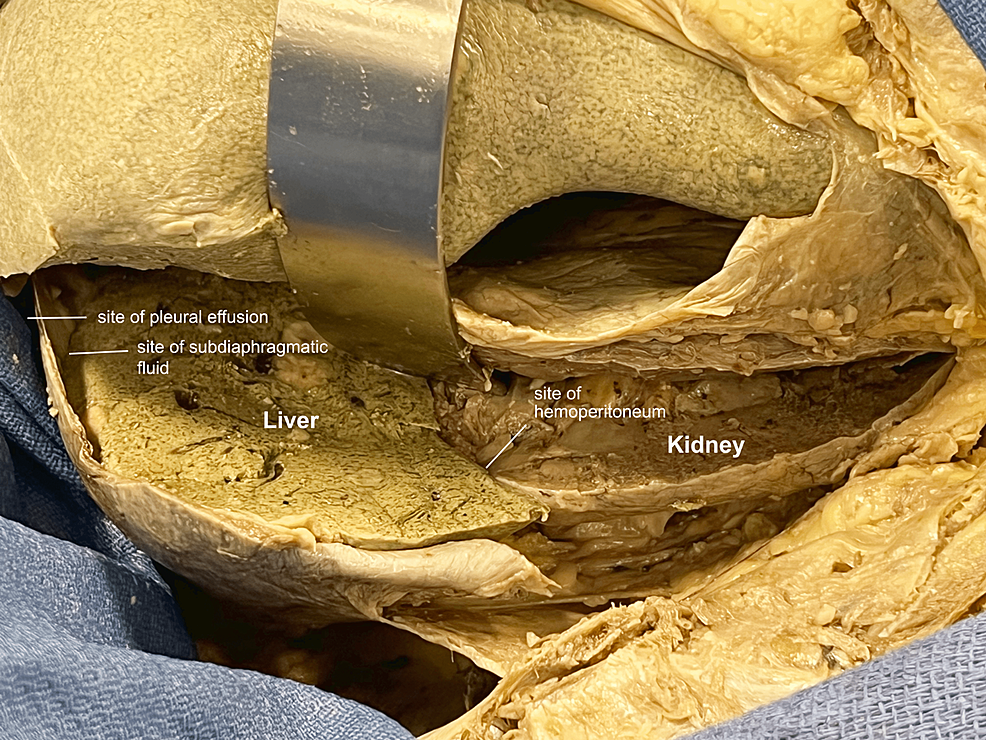 Anatomical Correlation For Focused Assessment With Sonography In Trauma