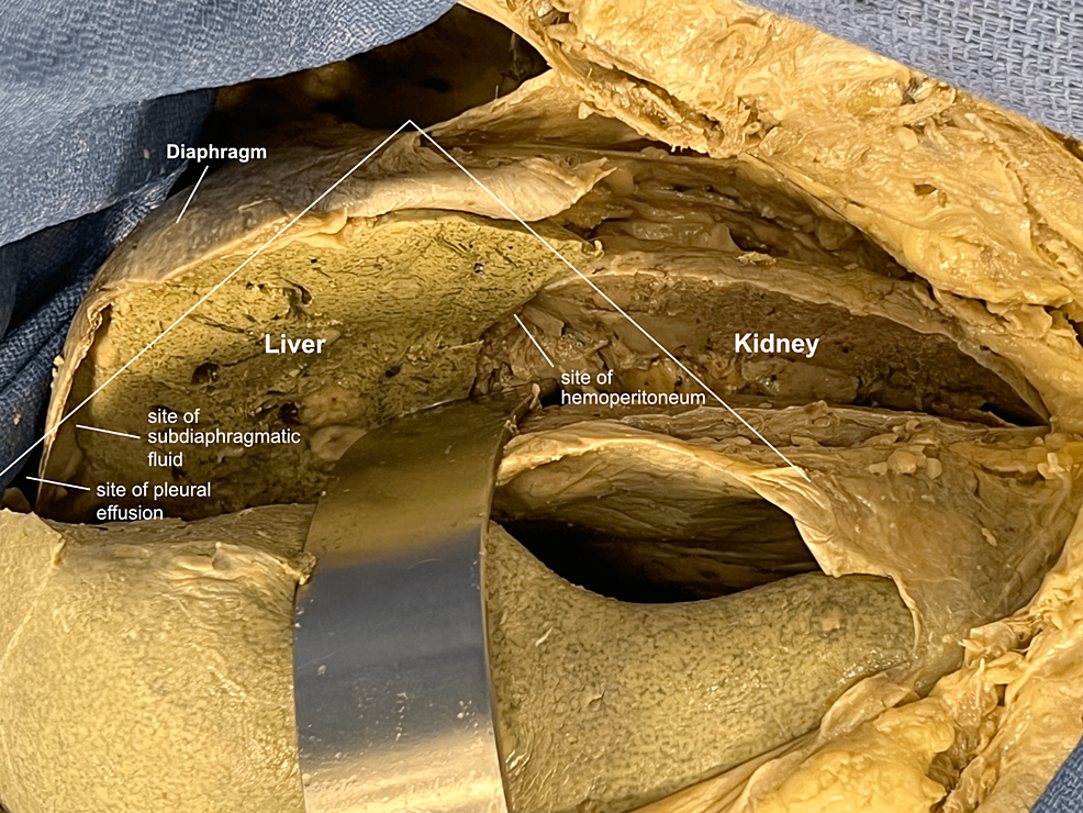 Cureus Anatomical Correlation For Focused Assessment With Sonography