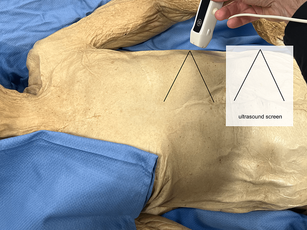 Anatomical Correlation For Focused Assessment With Sonography In Trauma