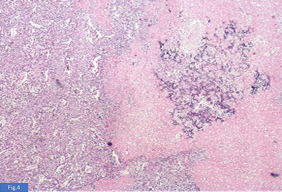 Osteosarcoma Originating From A Malignant Phyllodes Tumor A Case