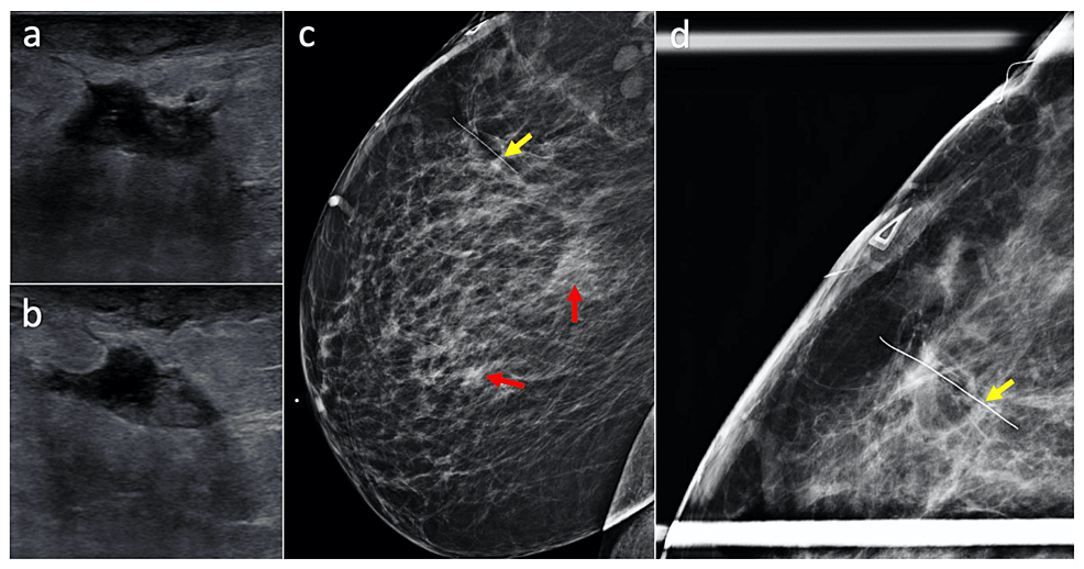 Mycobacterium Abscessus Causes Highly Resistant Infection As A Breast