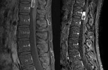 Mobile Schwannoma of the Lumbar Spine