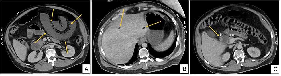 Cureus Bowel Ischemia Secondary To Campylobacter Enterocolitis A