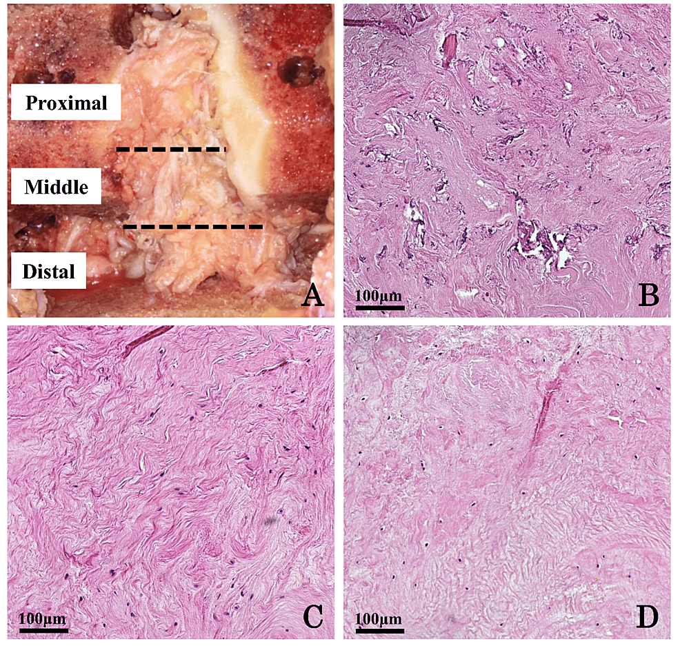 Gross Appearances Of The Posterior Cruciate Ligament Correlate With Its