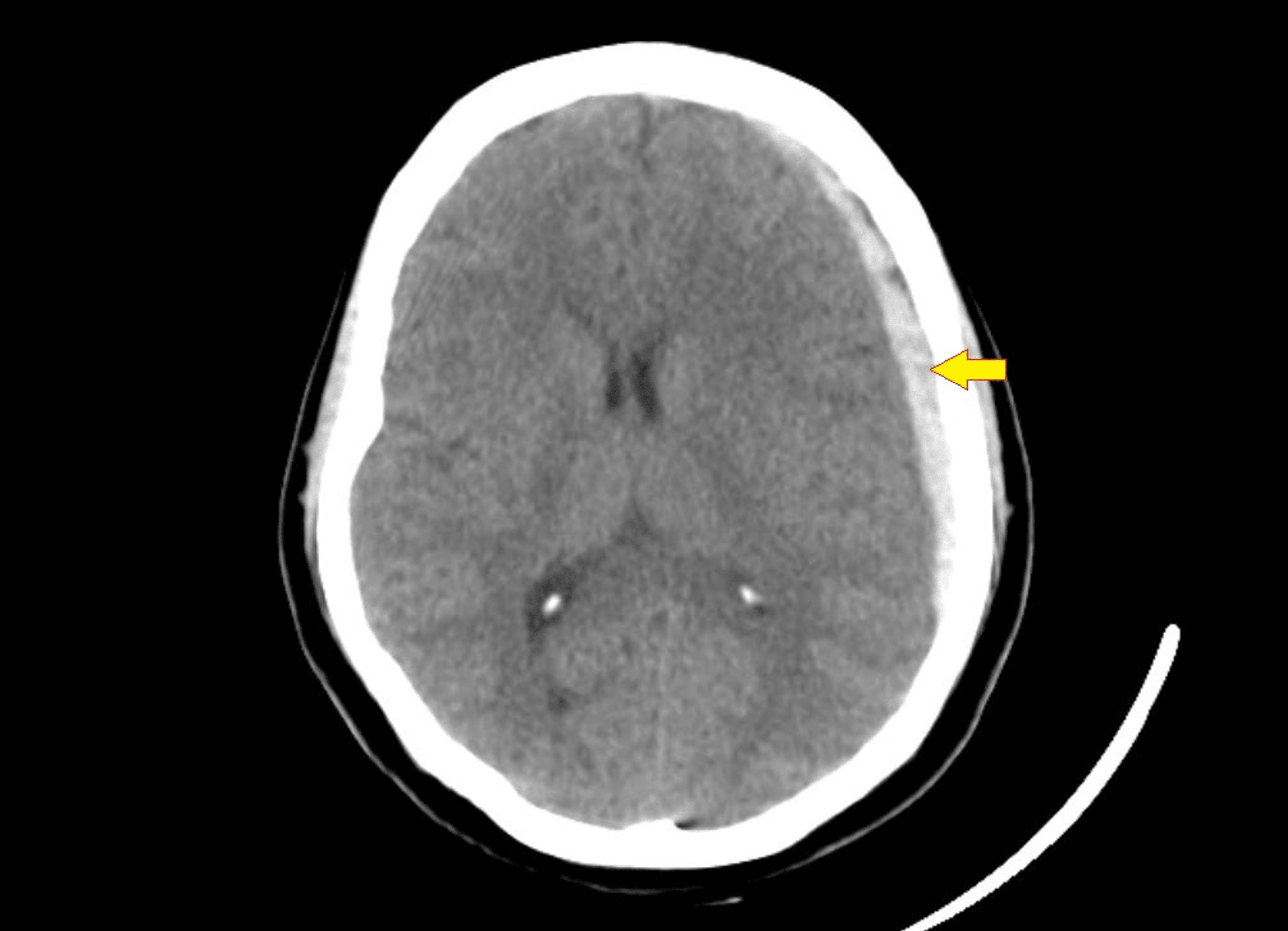 Cureus When A Headache Means More A Case Report Of Acute Spontaneous Subdural Hematoma After