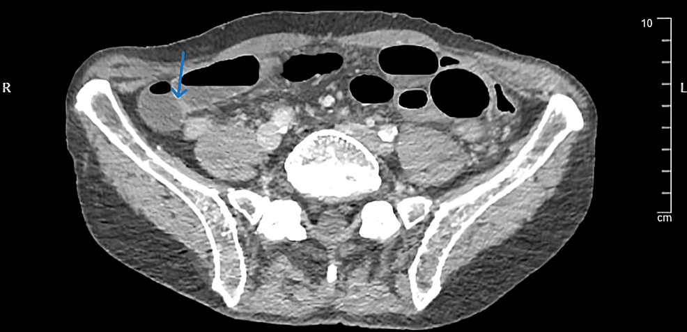 Erector Spinae Plane Block ESPB As An Alternative For Celiac Plexus