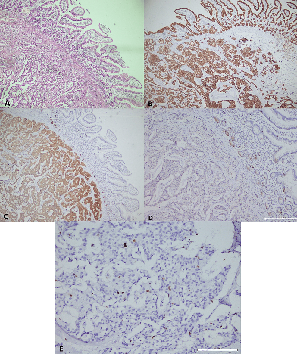 Cureus Neuroendocrine Tumor Of The Ampulla Of Vater A Case Report