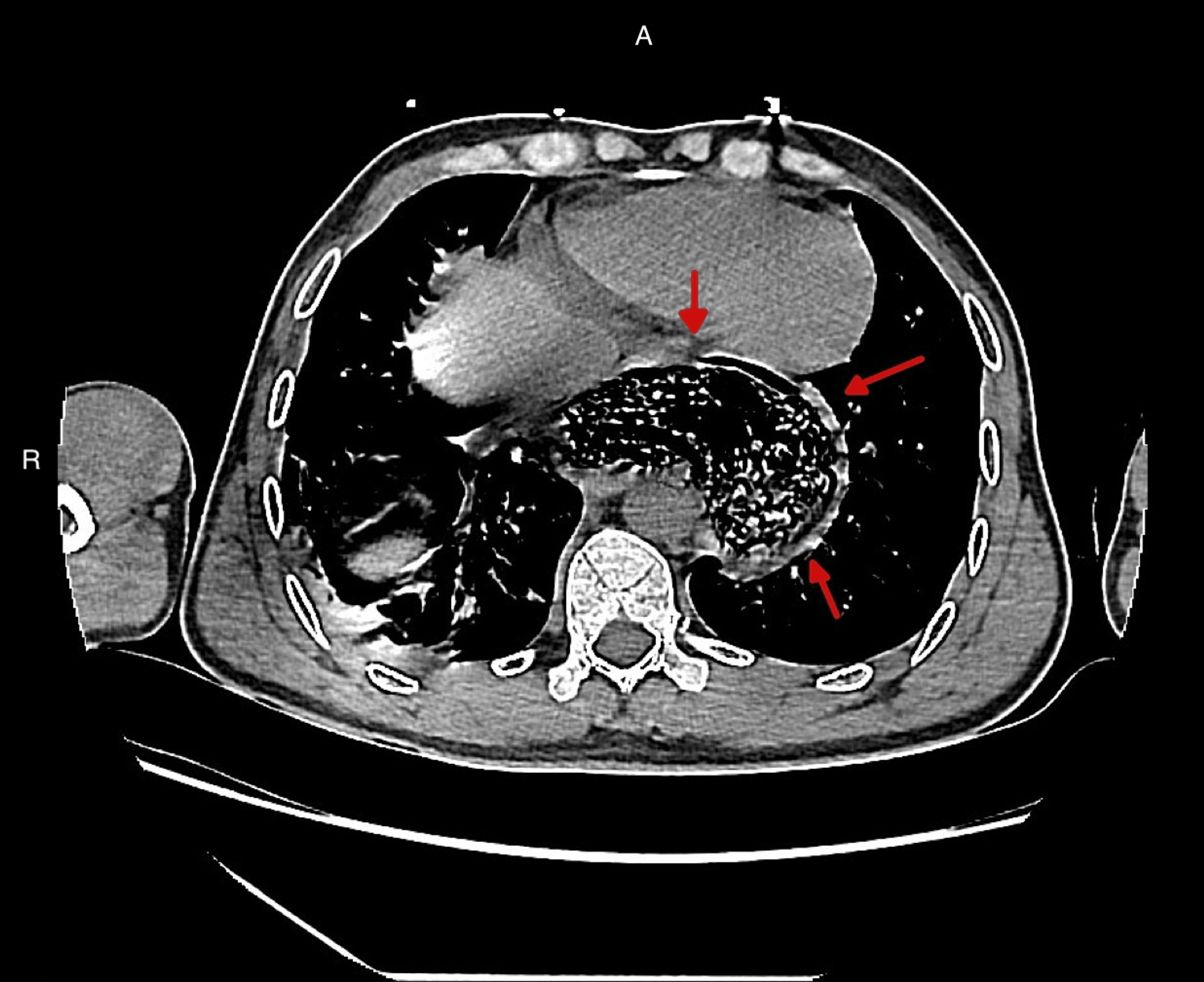 Acute Onset Achalasia Following A Recent COVID 19 Infection A Case