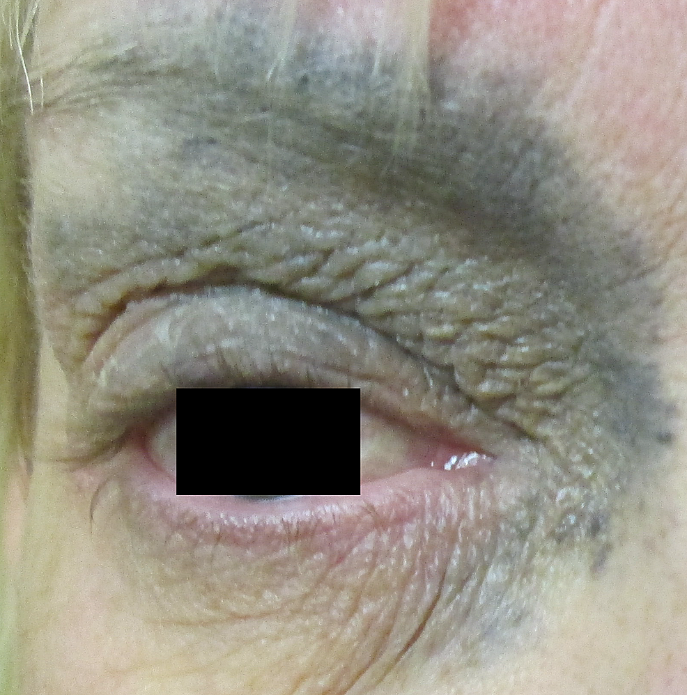 Cureus An Orbital Malignant Melanoma Arising in Cellular Blue Nevus