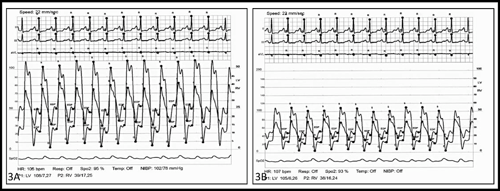 Cureus Constrictive Pericarditis A Diagnostic Conundrum