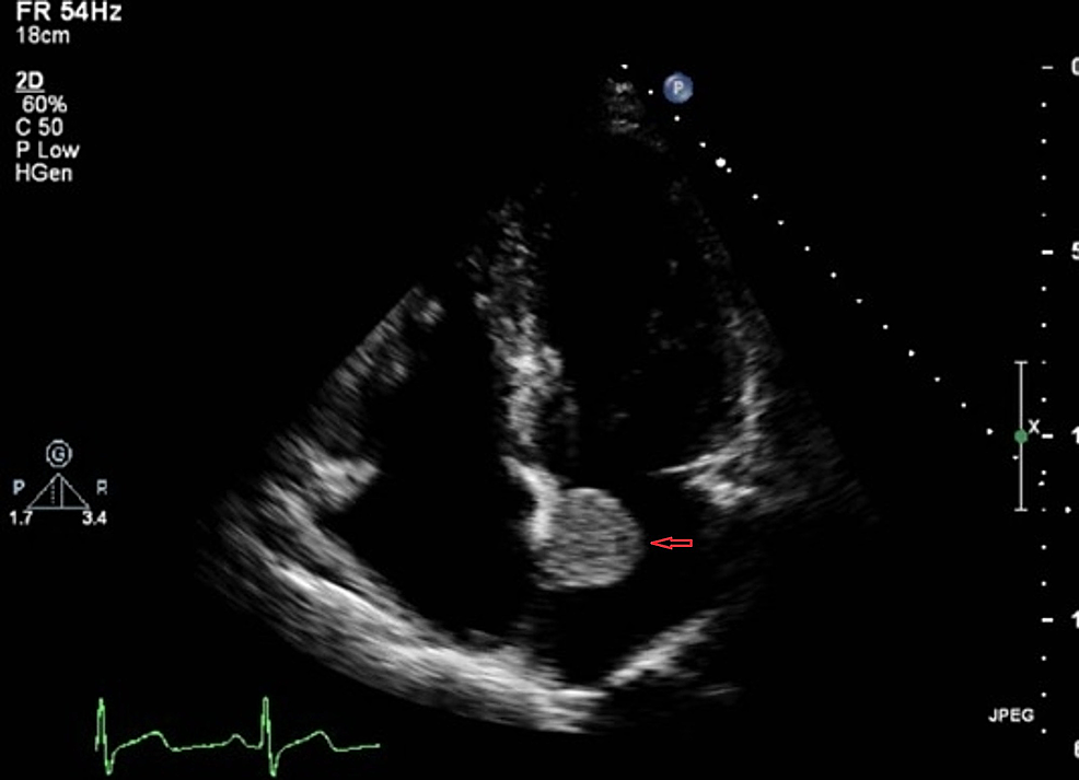 Cureus Left Atrial Myxoma Associated With Malignant Anomalous Course