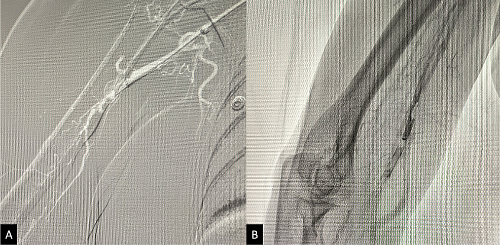 Endovascular Management Of Spontaneous Subclavian Artery Dissection