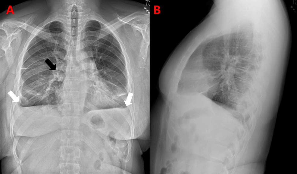 Multicentric Reticulohistiocytosis Presenting As Acute Pericarditis