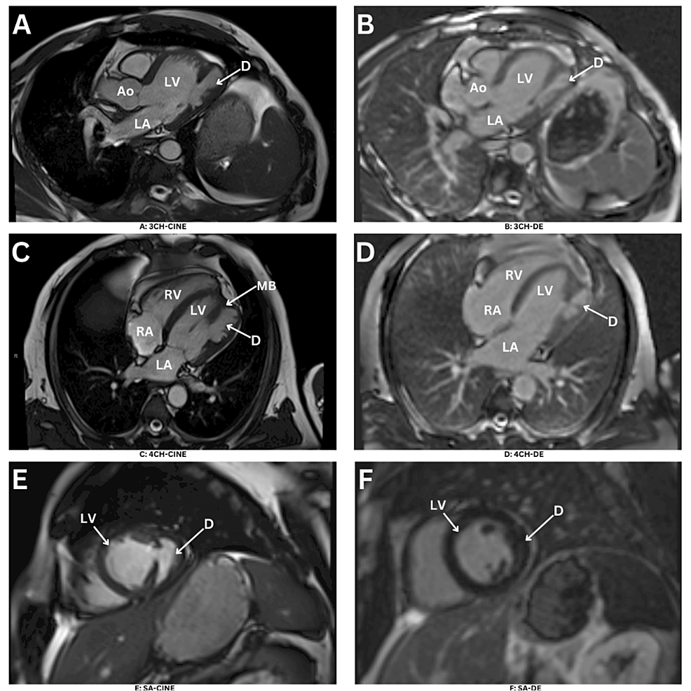 The Importance Of Advanced Imaging By Cardiac Magnetic Resonance