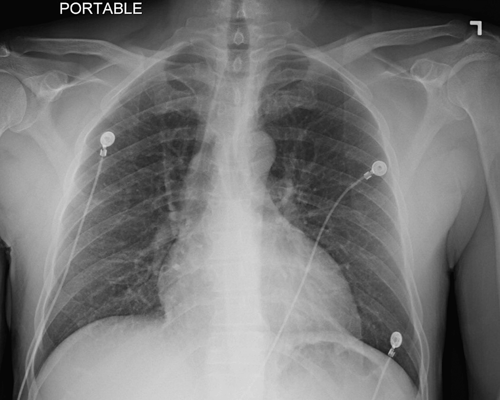 Cureus Unusual Aspergillus Pleural Effusion In A Patient With