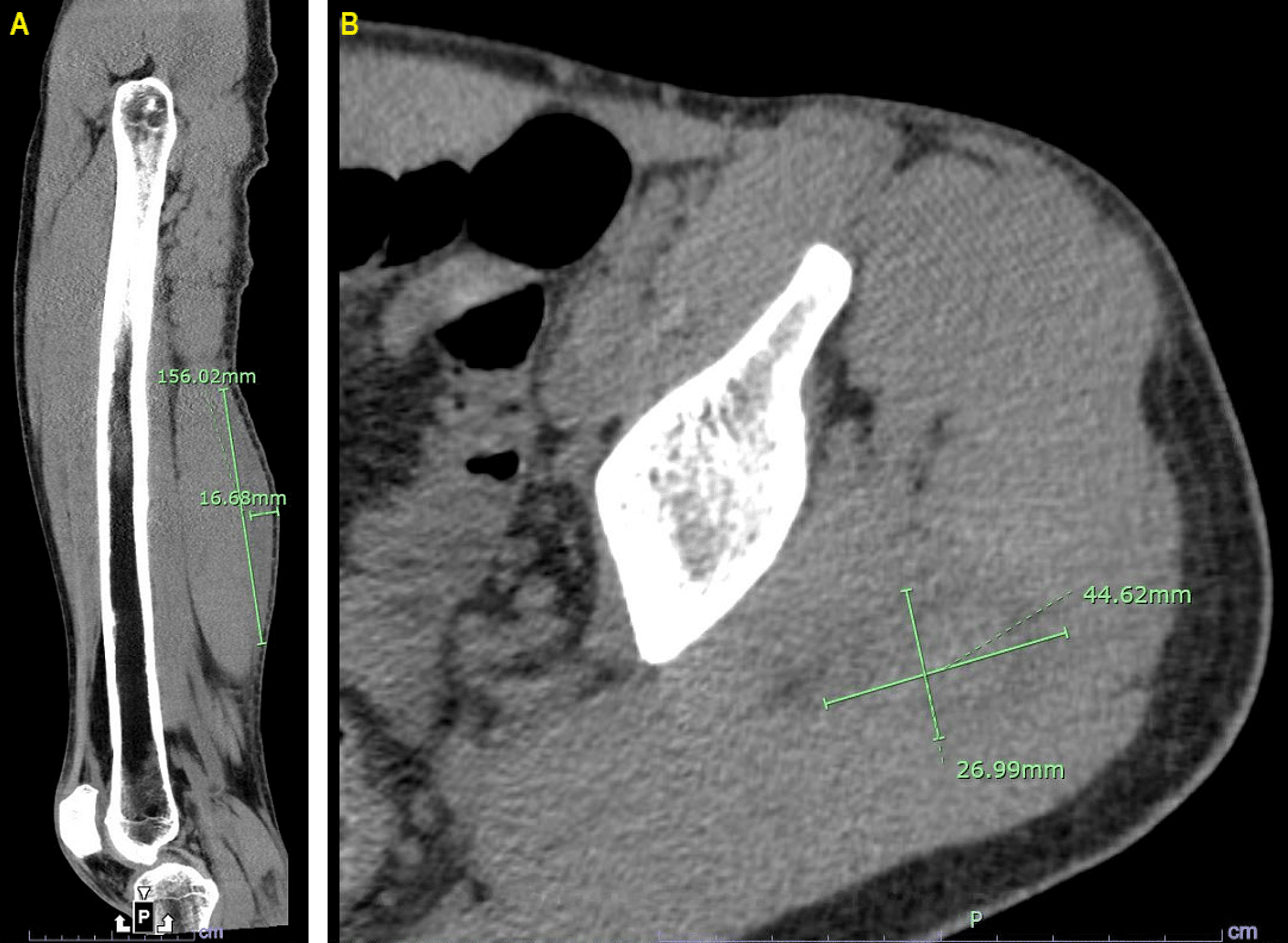 Cureus A Case Of Anaphylaxis To Novoseven In A Hemophiliac Patient