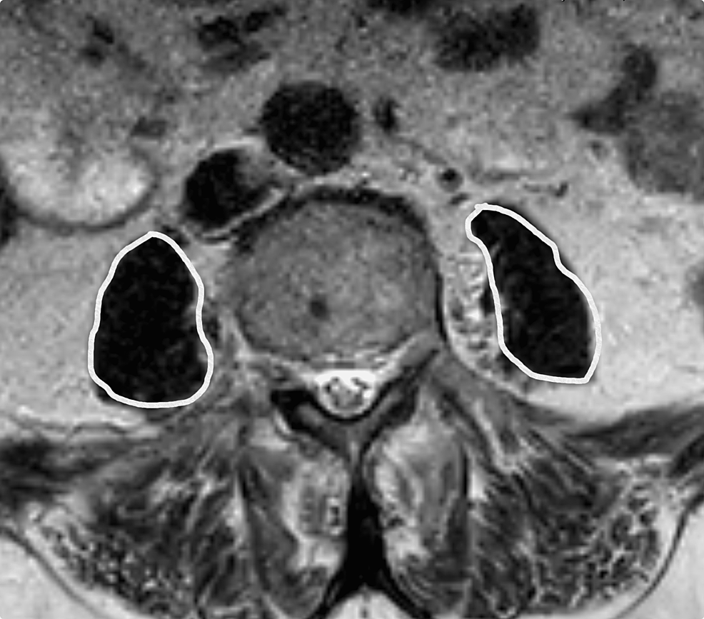 Evaluation Of Psoas Muscle Atrophy And The Degree Of Fat Infiltration