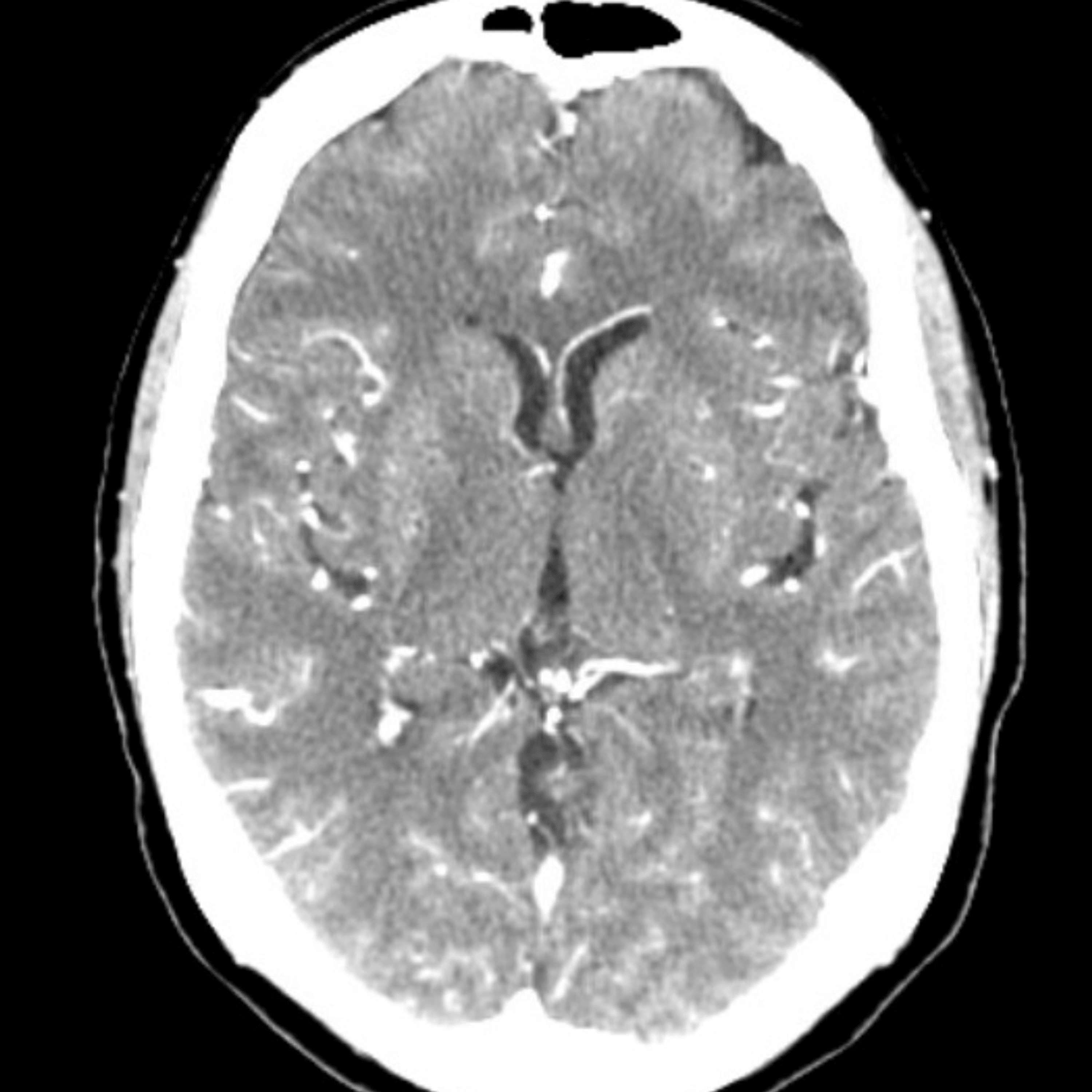 Unveiling The Truth Diagnosing Bacterial Meningitis Through Repeat