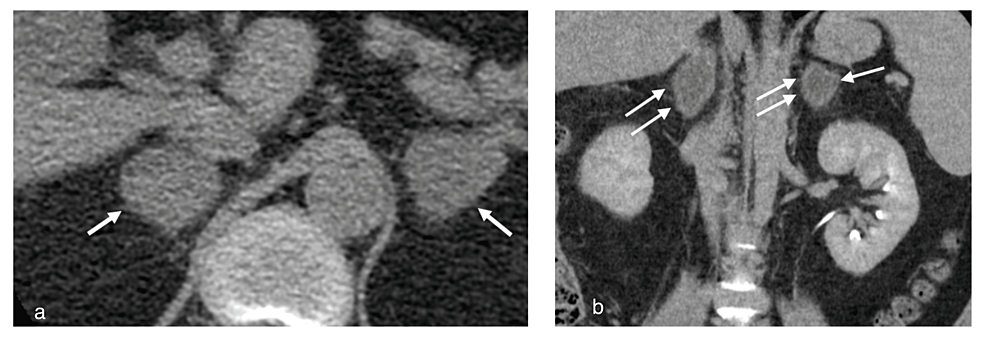 Vanishing Adrenal Glands Bilateral Adrenal Hemorrhage With Adrenal