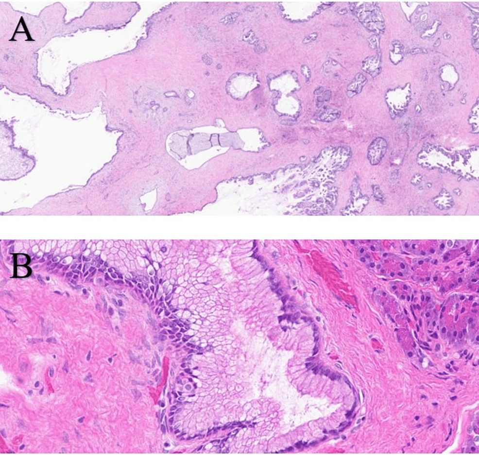 A Unicorn Disease The Large Duct Variant Of Invasive Ductal