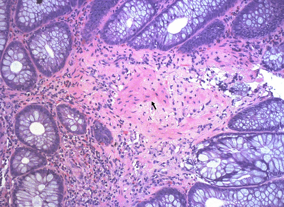 Intestinal Reactive Amyloid A AA Amyloidosis In A Patient With