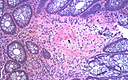 Intestinal Reactive Amyloid A AA Amyloidosis In A Patient With