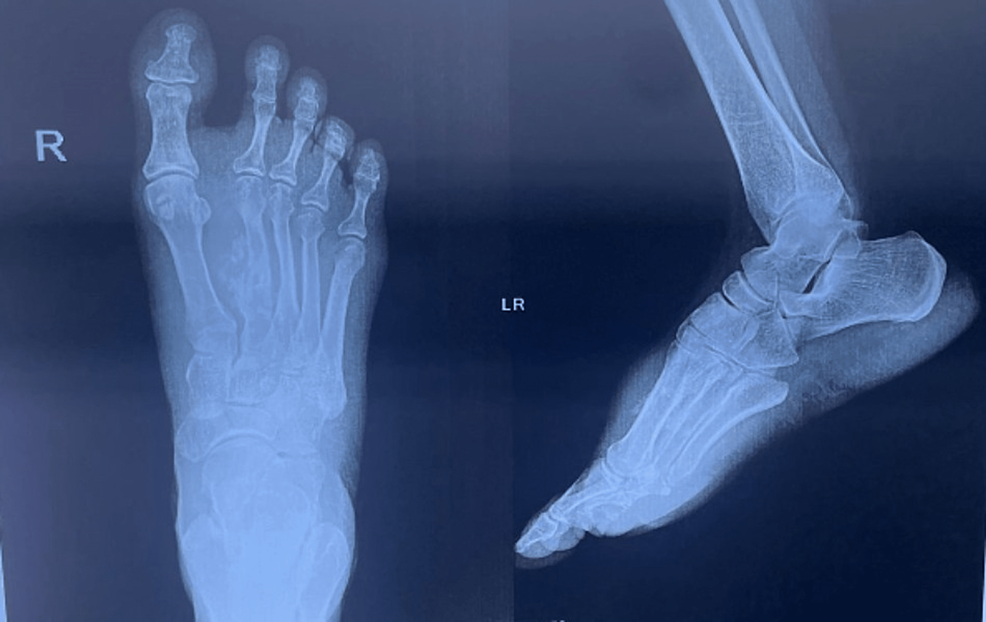 Surgical Triumph Over Metatarsal Osteosarcoma A Rare Case Report