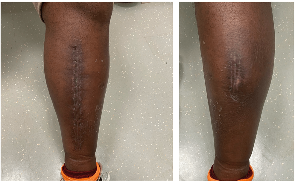 Atraumatic Idiopathic Compartment Syndrome Requiring Emergent