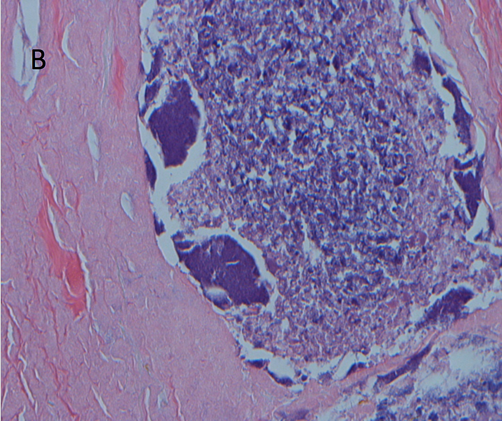 Cervical Actinomyces treatment