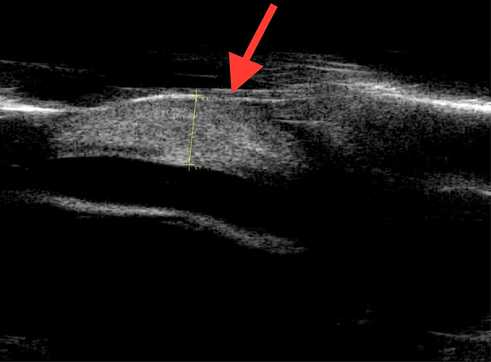 Cureus Bilateral Congenital Stromal Corneal Cysts Report Of A Unique