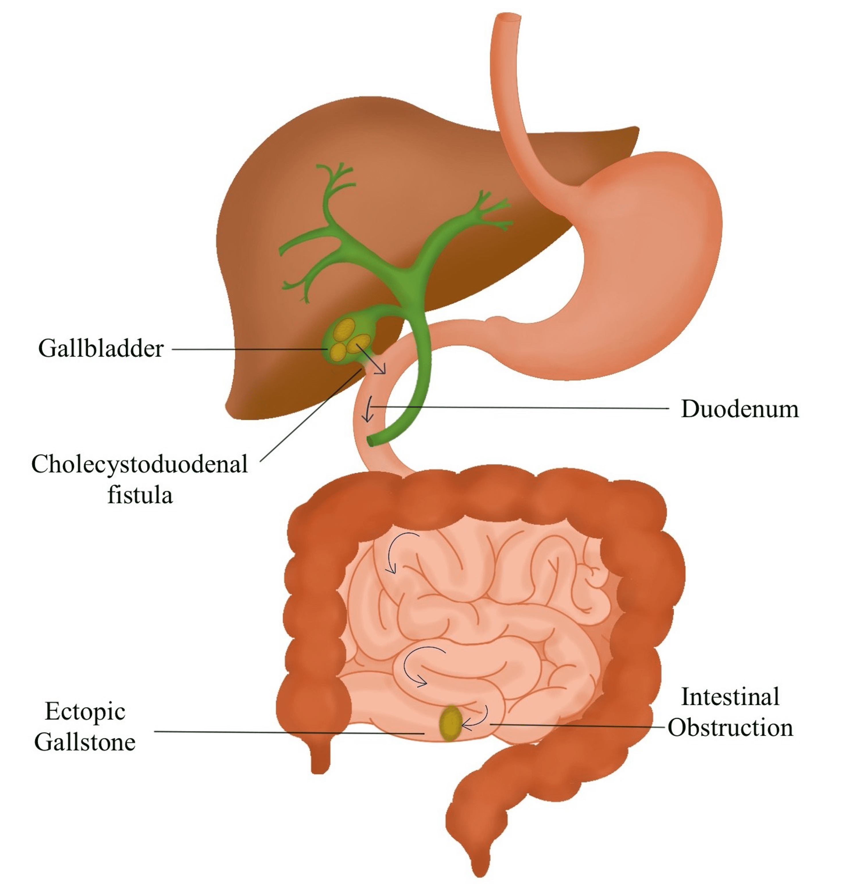 Gallstone Ileus Clinical Presentation And Radiological Diagnosis Cureus